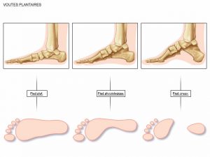 Claw toe : neurological causes of this deformation